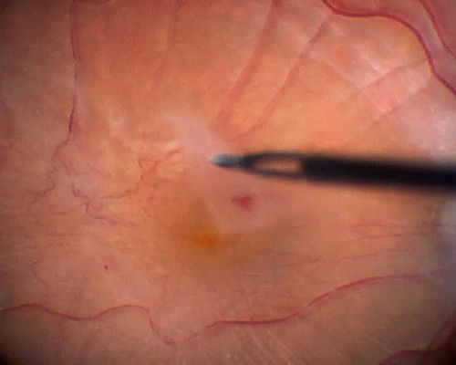 Vitrectomy with membrane peel
Intraoperative images showing the peeling of an epiretinal membrane - macular pucker - with a 25 gauge forcepts.
