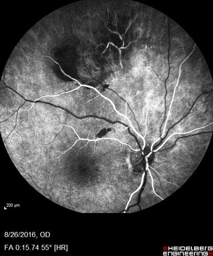 Peripheral exudative hemorrhagic chorioretinopathy - PECHR - Subfoveal fluid
85 year old female with 
Fluctuating   vision in the right eye.  
VA 20/200 OD, 20/32 OS
