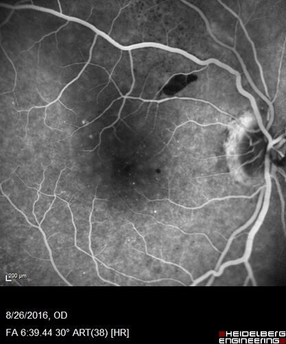 Peripheral exudative hemorrhagic chorioretinopathy - PECHR - Subfoveal fluid
85 year old female with 
Fluctuating   vision in the right eye.  
VA 20/200 OD, 20/32 OS
