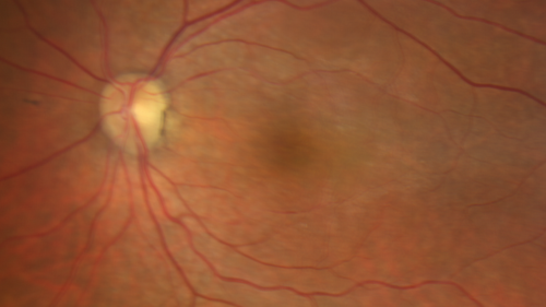 Perifoveal Microaneurysm - Not Diabetic (also reticular pseudodrusen)
87 year old female with fluctuating macular edema in the right eye from a perifoveal MA.  (no treatment).  VA 20/40 OU
