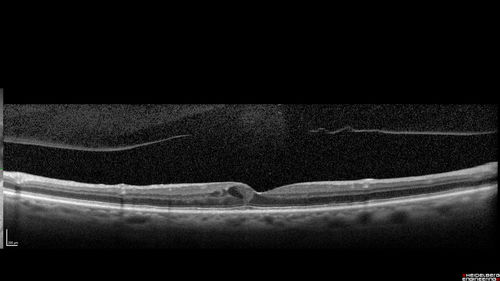 Perifoveal Microaneurysm - Not Diabetic (also reticular pseudodrusen)
87 year old female with fluctuating macular edema in the right eye from a perifoveal MA.  (no treatment).  VA 20/40 OU
