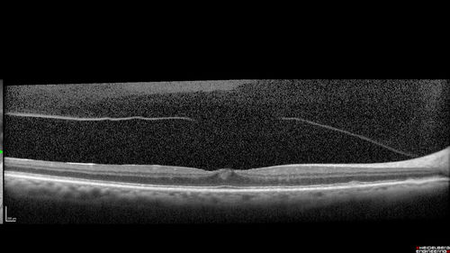 Perifoveal Microaneurysm - Not Diabetic (also reticular pseudodrusen)
87 year old female with fluctuating macular edema in the right eye from a perifoveal MA.  (no treatment).  VA 20/40 OU
