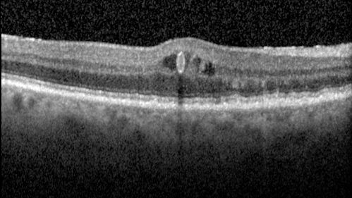 Perifoveal Microaneurysm - Not Diabetic (also reticular pseudodrusen)
87 year old female with fluctuating macular edema in the right eye from a perifoveal MA.  (no treatment).  VA 20/40 OU
