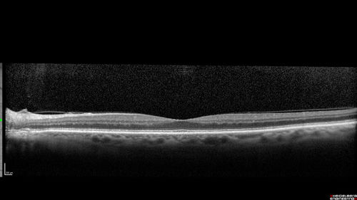 Perifoveal Microaneurysm - Not Diabetic (also reticular pseudodrusen)
87 year old female with fluctuating macular edema in the right eye from a perifoveal MA.  (no treatment).  VA 20/40 OU
