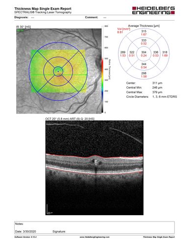 Perifoveal Microaneurysm - Not Diabetic (also reticular pseudodrusen)
87 year old female with fluctuating macular edema in the right eye from a perifoveal MA.  (no treatment).  VA 20/40 OU
