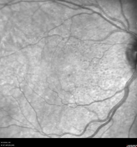 Perifoveal Microaneurysm - Not Diabetic (also reticular pseudodrusen)
87 year old female with fluctuating macular edema in the right eye from a perifoveal MA.  (no treatment).  VA 20/40 OU
