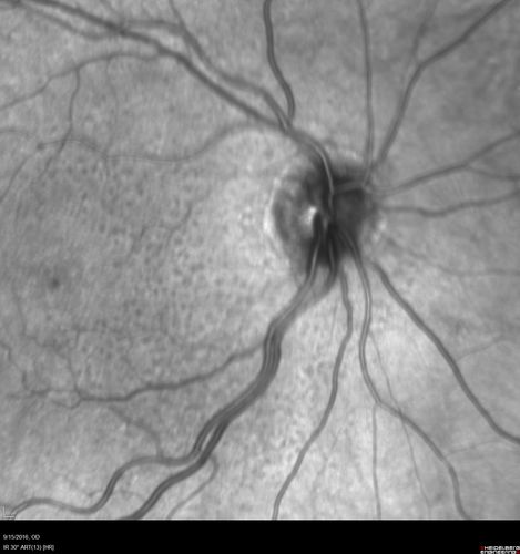 Perifoveal Microaneurysm - Not Diabetic (also reticular pseudodrusen)
87 year old female with fluctuating macular edema in the right eye from a perifoveal MA.  (no treatment).  VA 20/40 OU
