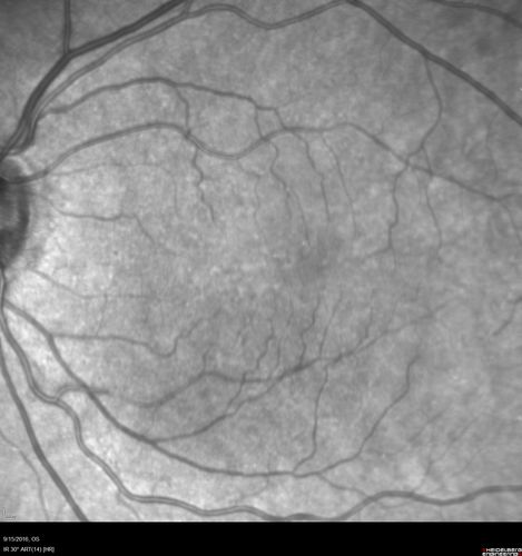 Perifoveal Microaneurysm - Not Diabetic (also reticular pseudodrusen)
87 year old female with fluctuating macular edema in the right eye from a perifoveal MA.  (no treatment).  VA 20/40 OU
