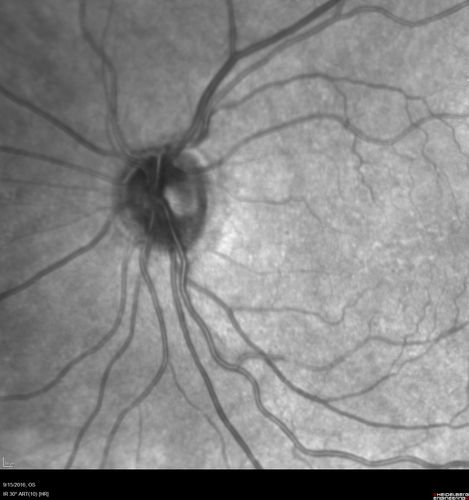 Perifoveal Microaneurysm - Not Diabetic (also reticular pseudodrusen)
87 year old female with fluctuating macular edema in the right eye from a perifoveal MA.  (no treatment).  VA 20/40 OU
