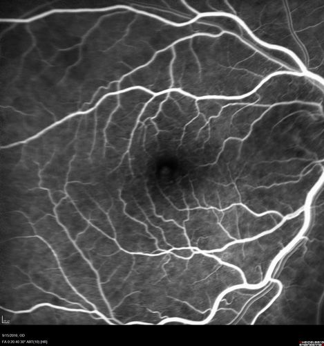 Perifoveal Microaneurysm - Not Diabetic (also reticular pseudodrusen)
87 year old female with fluctuating macular edema in the right eye from a perifoveal MA.  (no treatment).  VA 20/40 OU
