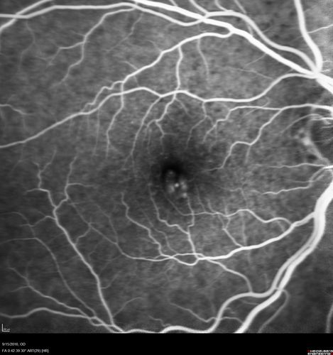 Perifoveal Microaneurysm - Not Diabetic (also reticular pseudodrusen)
87 year old female with fluctuating macular edema in the right eye from a perifoveal MA.  (no treatment).  VA 20/40 OU
