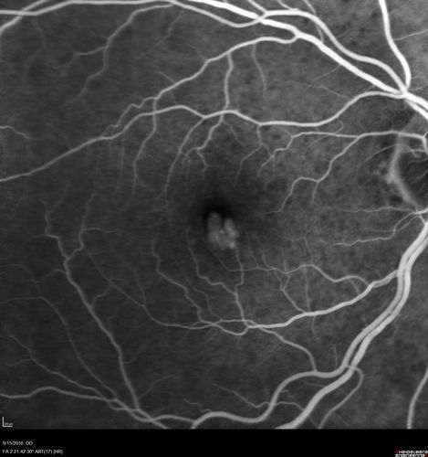 Perifoveal Microaneurysm - Not Diabetic (also reticular pseudodrusen)
87 year old female with fluctuating macular edema in the right eye from a perifoveal MA.  (no treatment).  VA 20/40 OU
