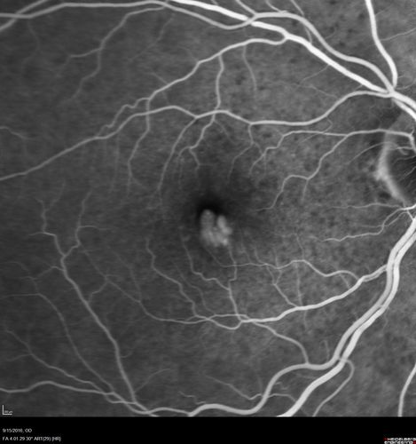 Perifoveal Microaneurysm - Not Diabetic (also reticular pseudodrusen)
87 year old female with fluctuating macular edema in the right eye from a perifoveal MA.  (no treatment).  VA 20/40 OU
