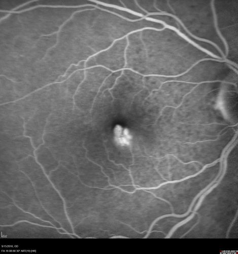 Perifoveal Microaneurysm - Not Diabetic (also reticular pseudodrusen)
87 year old female with fluctuating macular edema in the right eye from a perifoveal MA.  (no treatment).  VA 20/40 OU
