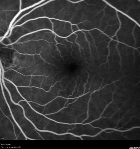 Perifoveal Microaneurysm - Not Diabetic (also reticular pseudodrusen)
87 year old female with fluctuating macular edema in the right eye from a perifoveal MA.  (no treatment).  VA 20/40 OU
