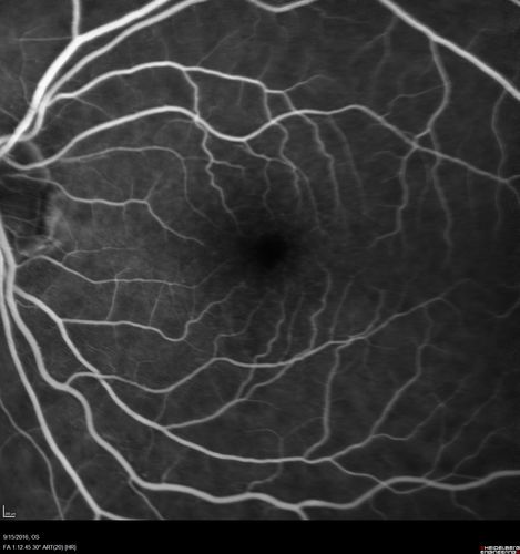 Perifoveal Microaneurysm - Not Diabetic (also reticular pseudodrusen)
87 year old female with fluctuating macular edema in the right eye from a perifoveal MA.  (no treatment).  VA 20/40 OU
