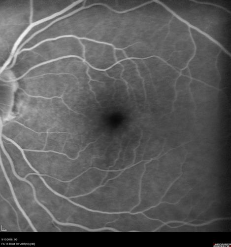 Perifoveal Microaneurysm - Not Diabetic (also reticular pseudodrusen)
87 year old female with fluctuating macular edema in the right eye from a perifoveal MA.  (no treatment).  VA 20/40 OU
