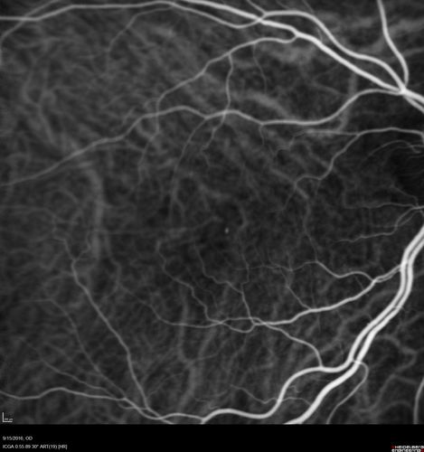 Perifoveal Microaneurysm - Not Diabetic (also reticular pseudodrusen)
87 year old female with fluctuating macular edema in the right eye from a perifoveal MA.  (no treatment).  VA 20/40 OU
