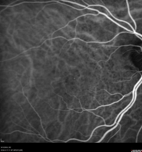 Perifoveal Microaneurysm - Not Diabetic (also reticular pseudodrusen)
87 year old female with fluctuating macular edema in the right eye from a perifoveal MA.  (no treatment).  VA 20/40 OU
