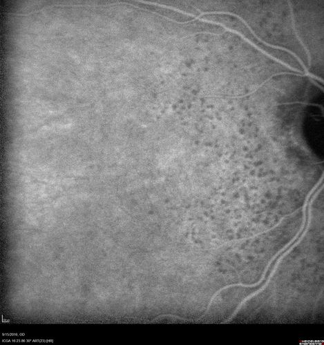 Perifoveal Microaneurysm - Not Diabetic (also reticular pseudodrusen)
87 year old female with fluctuating macular edema in the right eye from a perifoveal MA.  (no treatment).  VA 20/40 OU
