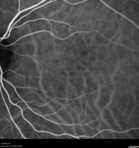 Perifoveal Microaneurysm - Not Diabetic (also reticular pseudodrusen)
87 year old female with fluctuating macular edema in the right eye from a perifoveal MA.  (no treatment).  VA 20/40 OU
