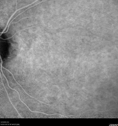 Perifoveal Microaneurysm - Not Diabetic (also reticular pseudodrusen)
87 year old female with fluctuating macular edema in the right eye from a perifoveal MA.  (no treatment).  VA 20/40 OU
