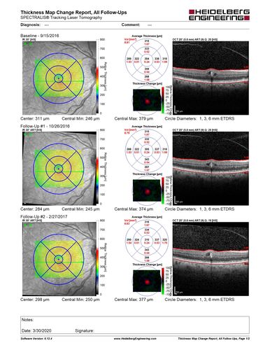 Perifoveal Microaneurysm - Not Diabetic (also reticular pseudodrusen)
87 year old female with fluctuating macular edema in the right eye from a perifoveal MA.  (no treatment).  VA 20/40 OU
