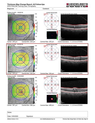 Perifoveal Microaneurysm - Not Diabetic (also reticular pseudodrusen)
87 year old female with fluctuating macular edema in the right eye from a perifoveal MA.  (no treatment).  VA 20/40 OU
