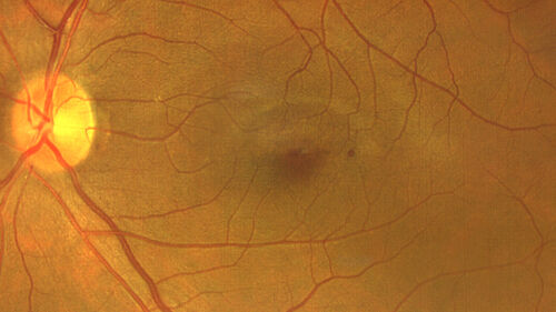 Perivascular Exudative Vascular Complex - Perifoveal Microaneurysm
59 year old man - asymptomatic - not diabetic

