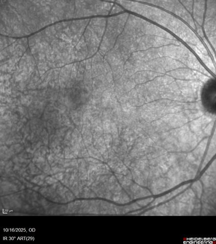 Perivascular Exudative Vascular Complex - Perifoveal Microaneurysm
59 year old man - asymptomatic - not diabetic
