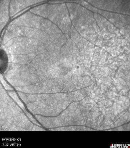 Perivascular Exudative Vascular Complex - Perifoveal Microaneurysm
59 year old man - asymptomatic - not diabetic
