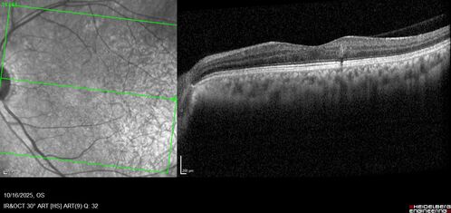 Perivascular Exudative Vascular Complex - Perifoveal Microaneurysm
59 year old man - asymptomatic - not diabetic
