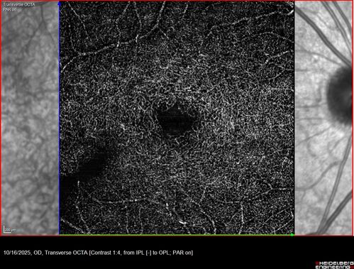 Perivascular Exudative Vascular Complex - Perifoveal Microaneurysm
59 year old man - asymptomatic - not diabetic

