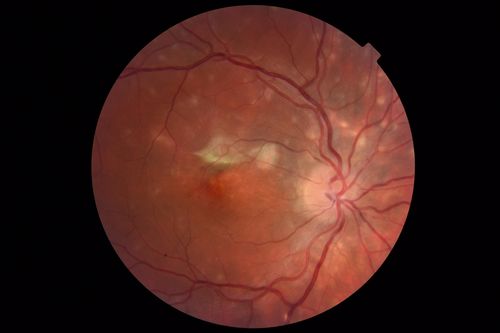 Punctate Inner Choroidopathy and Choroidal Neovascular Membrane
27 year old female with vision loss for 4 months. VA was 20/200.  She had a CNVM which was extrafoveal with no subretinal fluid.  Her vision improved over 6 months to 20/50 with Ranibizumab injections (she might have improved without treatment)
