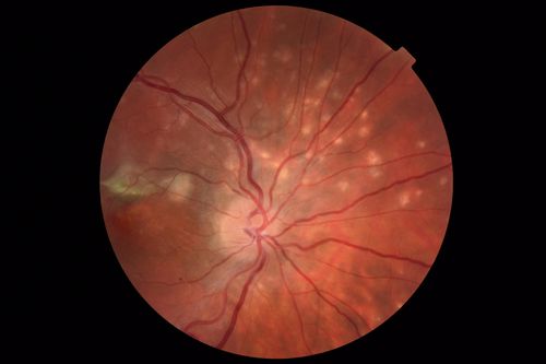 Punctate Inner Choroidopathy and Choroidal Neovascular Membrane
27 year old female with vision loss for 4 months. VA was 20/200.  She had a CNVM which was extrafoveal with no subretinal fluid.  Her vision improved over 6 months to 20/50 with Ranibizumab injections (she might have improved without treatment)
