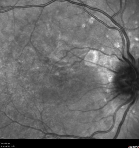 Punctate Inner Choroidopathy and Choroidal Neovascular Membrane
27 year old female with vision loss for 4 months. VA was 20/200.  She had a CNVM which was extrafoveal with no subretinal fluid.  Her vision improved over 6 months to 20/50 with Ranibizumab injections (she might have improved without treatment)
