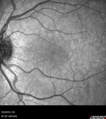 Punctate Inner Choroidopathy and Choroidal Neovascular Membrane
27 year old female with vision loss for 4 months. VA was 20/200.  She had a CNVM which was extrafoveal with no subretinal fluid.  Her vision improved over 6 months to 20/50 with Ranibizumab injections (she might have improved without treatment)
