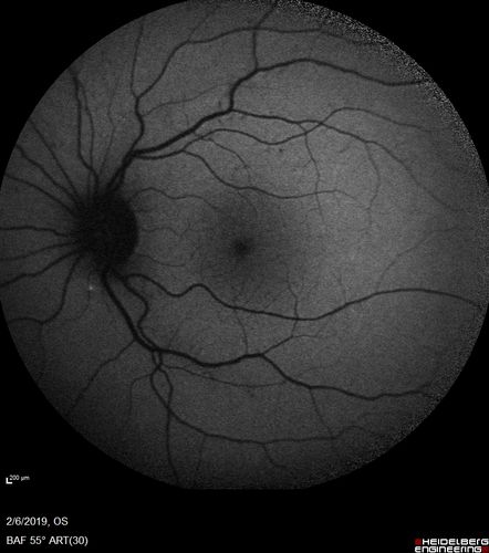 Punctate Inner Choroidopathy and Choroidal Neovascular Membrane
27 year old female with vision loss for 4 months. VA was 20/200.  She had a CNVM which was extrafoveal with no subretinal fluid.  Her vision improved over 6 months to 20/50 with Ranibizumab injections (she might have improved without treatment)
