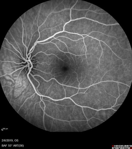 Punctate Inner Choroidopathy and Choroidal Neovascular Membrane
27 year old female with vision loss for 4 months. VA was 20/200.  She had a CNVM which was extrafoveal with no subretinal fluid.  Her vision improved over 6 months to 20/50 with Ranibizumab injections (she might have improved without treatment)
