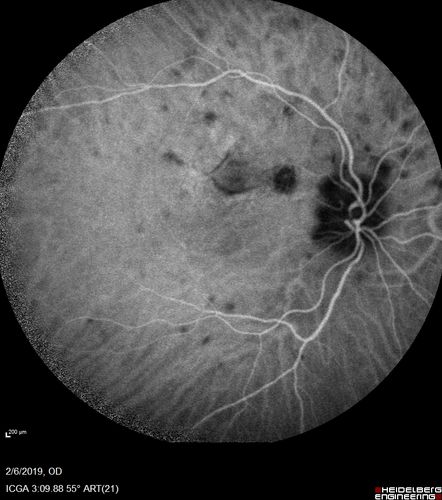 Punctate Inner Choroidopathy and Choroidal Neovascular Membrane
27 year old female with vision loss for 4 months. VA was 20/200.  She had a CNVM which was extrafoveal with no subretinal fluid.  Her vision improved over 6 months to 20/50 with Ranibizumab injections (she might have improved without treatment)
