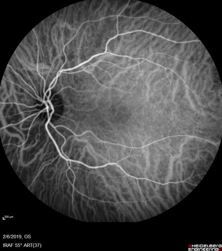 Punctate Inner Choroidopathy and Choroidal Neovascular Membrane
27 year old female with vision loss for 4 months. VA was 20/200.  She had a CNVM which was extrafoveal with no subretinal fluid.  Her vision improved over 6 months to 20/50 with Ranibizumab injections (she might have improved without treatment)
