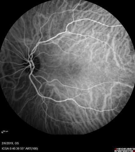 Punctate Inner Choroidopathy and Choroidal Neovascular Membrane
27 year old female with vision loss for 4 months. VA was 20/200.  She had a CNVM which was extrafoveal with no subretinal fluid.  Her vision improved over 6 months to 20/50 with Ranibizumab injections (she might have improved without treatment)

