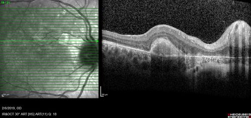 Punctate Inner Choroidopathy and Choroidal Neovascular Membrane
27 year old female with vision loss for 4 months. VA was 20/200.  She had a CNVM which was extrafoveal with no subretinal fluid.  Her vision improved over 6 months to 20/50 with Ranibizumab injections (she might have improved without treatment)
