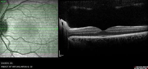 Punctate Inner Choroidopathy and Choroidal Neovascular Membrane
27 year old female with vision loss for 4 months. VA was 20/200.  She had a CNVM which was extrafoveal with no subretinal fluid.  Her vision improved over 6 months to 20/50 with Ranibizumab injections (she might have improved without treatment)

