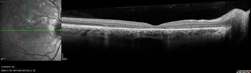 Punctate Inner Choroidopathy and Choroidal Neovascular Membrane
27 year old female with vision loss for 4 months. VA was 20/200.  She had a CNVM which was extrafoveal with no subretinal fluid.  Her vision improved over 6 months to 20/50 with Ranibizumab injections (she might have improved without treatment)
