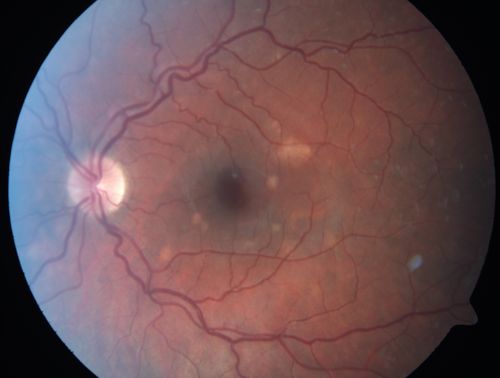 Punctate Inner Choroidopathy - PIC and Choroidal Neovascular Membrane - Right Eye - Color Fundus Photograph
34-year-old woman with a change in vision in the right eye about eight days ago.  Her vision was hazy and she saw waviness in the vision.  She does have a history of aches and pains and she was diagnosed with Sjogrenâ€™s and 2 months ago she had some fevers and some sinus drainage and that went on for about two months.  She is a moderate myope.    OD 20/25, OS 20/20.   
