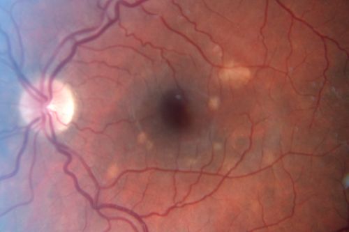 Punctate Inner Choroidopathy - PIC and Choroidal Neovascular Membrane - Right Eye - Color Fundus Photograph
34-year-old woman with a change in vision in the right eye about eight days ago.  Her vision was hazy and she saw waviness in the vision.  She does have a history of aches and pains and she was diagnosed with Sjogrenâ€™s and 2 months ago she had some fevers and some sinus drainage and that went on for about two months.  She is a moderate myope.    OD 20/25, OS 20/20.   
