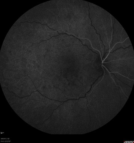 Punctate Inner Choroidopathy - PIC and Choroidal Neovascular Membrane - Right Eye - Fluorescein Angiogram
34-year-old woman with a change in vision in the right eye about eight days ago.  Her vision was hazy and she saw waviness in the vision.  She does have a history of aches and pains and she was diagnosed with Sjogrenâ€™s and 2 months ago she had some fevers and some sinus drainage and that went on for about two months.  She is a moderate myope.    OD 20/25, OS 20/20.   
