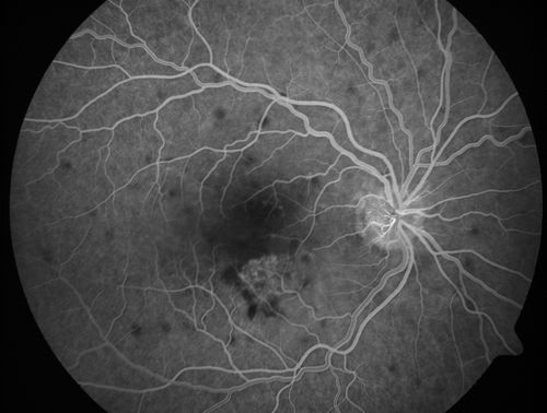 Punctate Inner Choroidopathy - PIC and Choroidal Neovascular Membrane - Right Eye - Fluorescein Angiogram
34-year-old woman with a change in vision in the right eye about eight days ago.  Her vision was hazy and she saw waviness in the vision.  She does have a history of aches and pains and she was diagnosed with Sjogrenâ€™s and 2 months ago she had some fevers and some sinus drainage and that went on for about two months.  She is a moderate myope.    OD 20/25, OS 20/20.   
