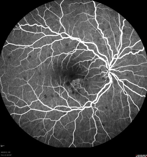 Punctate Inner Choroidopathy - PIC and Choroidal Neovascular Membrane - Right Eye - Fluorescein Angiogram
34-year-old woman with a change in vision in the right eye about eight days ago.  Her vision was hazy and she saw waviness in the vision.  She does have a history of aches and pains and she was diagnosed with Sjogrenâ€™s and 2 months ago she had some fevers and some sinus drainage and that went on for about two months.  She is a moderate myope.    OD 20/25, OS 20/20.   
